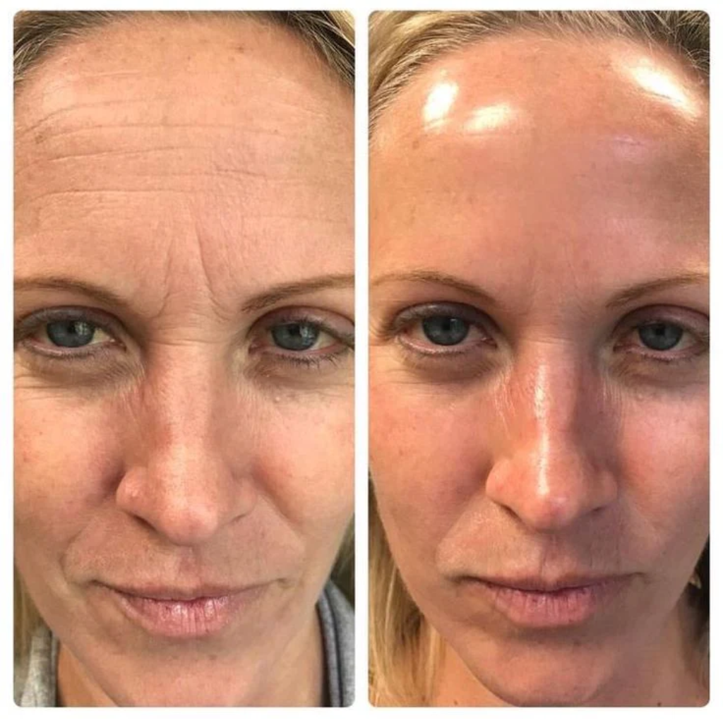 Fiorea® Retinal Shot - Adiós Arrugas