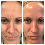 Fiorea® Retinal Shot - Adiós Arrugas